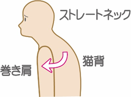 巻き肩と猫背の違いとは？